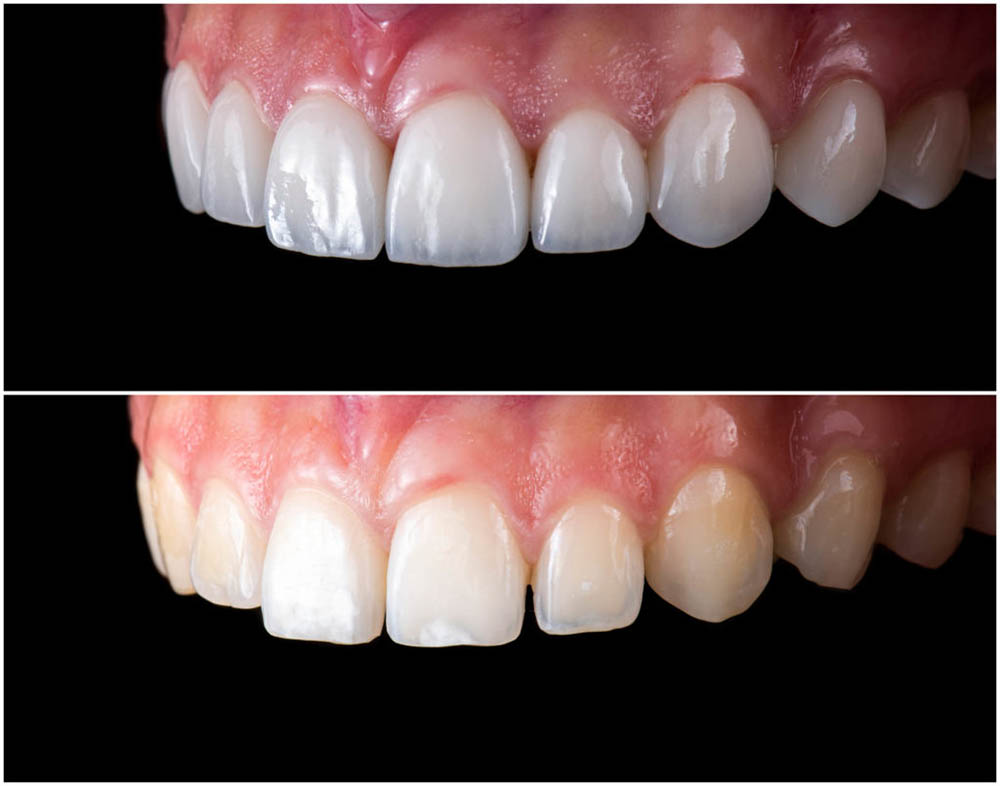 オールセラミック（ジルコニア）