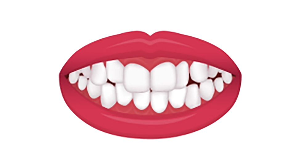 叢生（そうせい：歯がデコボコした状態で並んでいる）