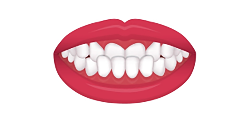 下顎前突（受け口）