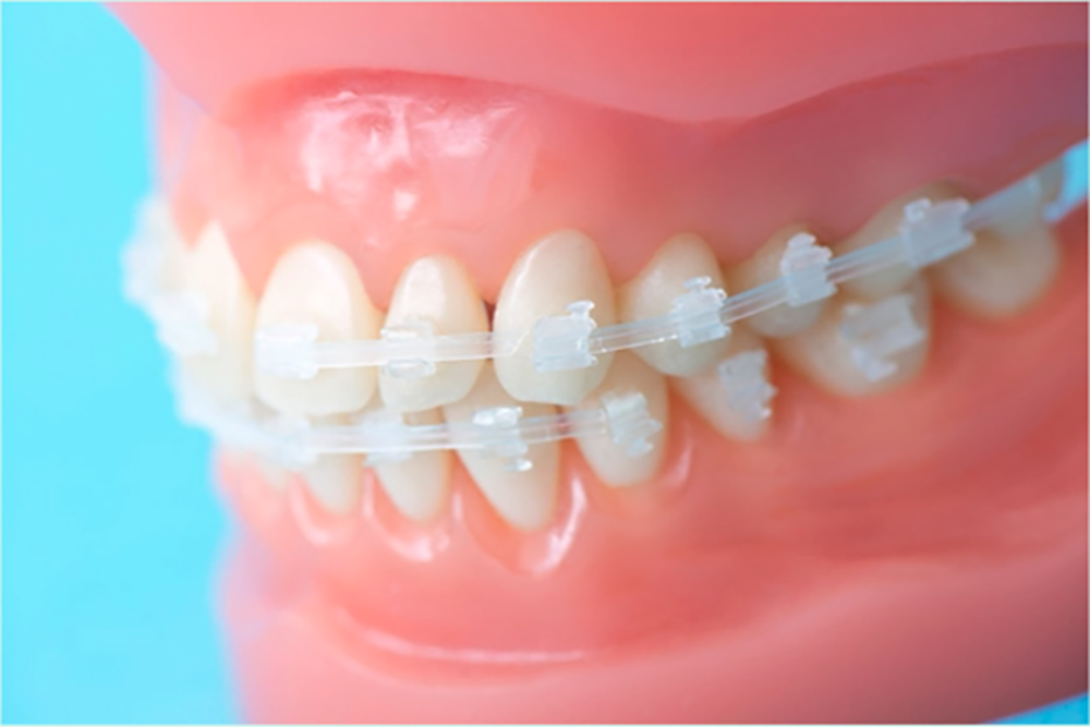 セラミックブラケット