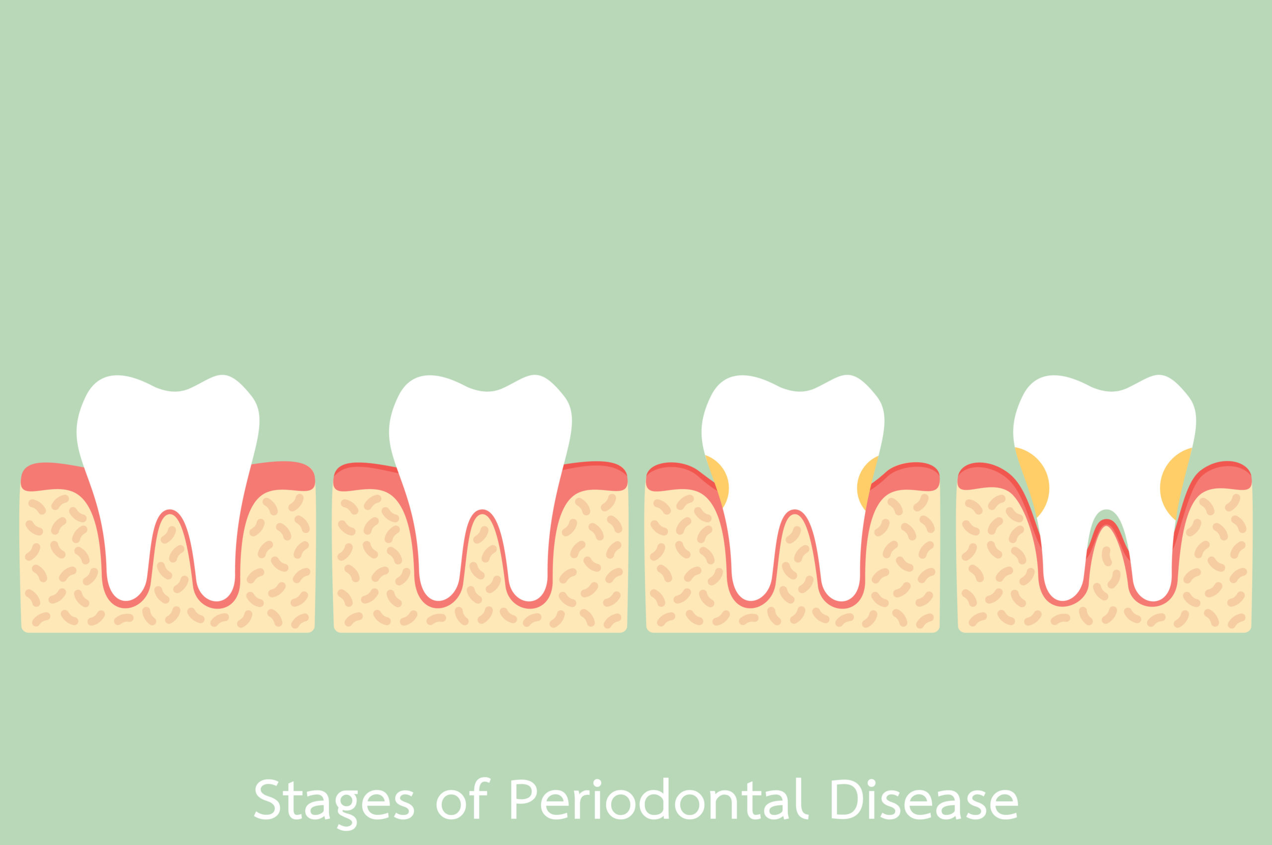 みよし市　歯医者　歯周病　後藤歯科
