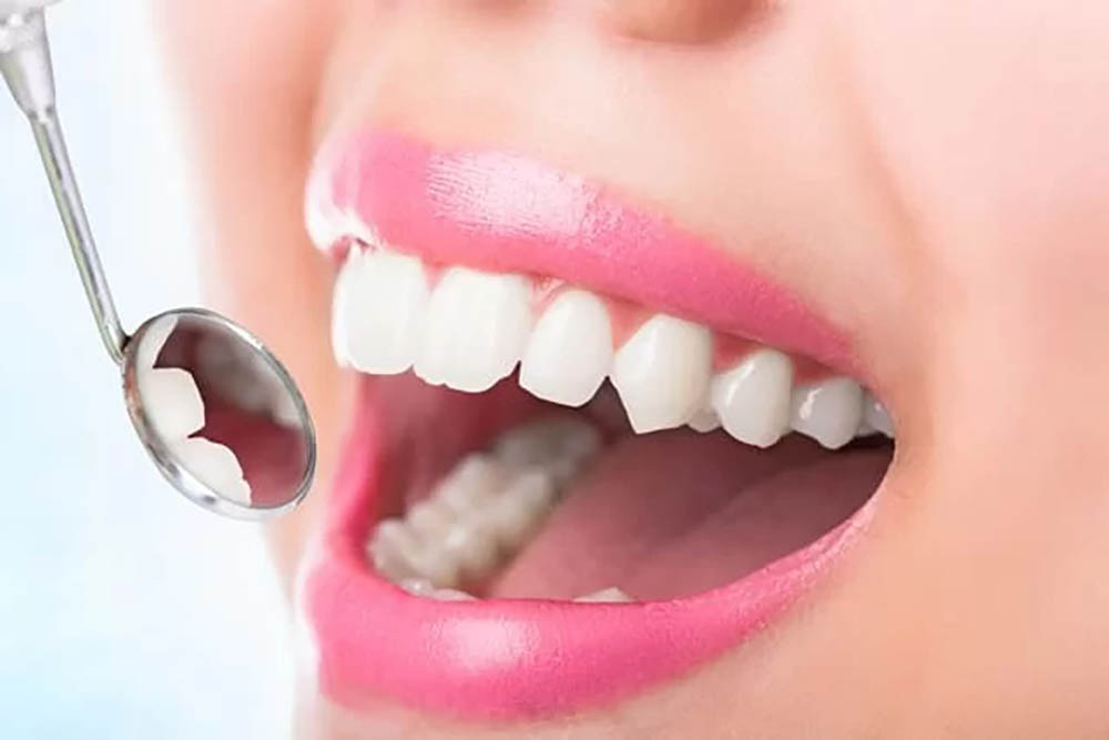 ホワイトニングの注意点