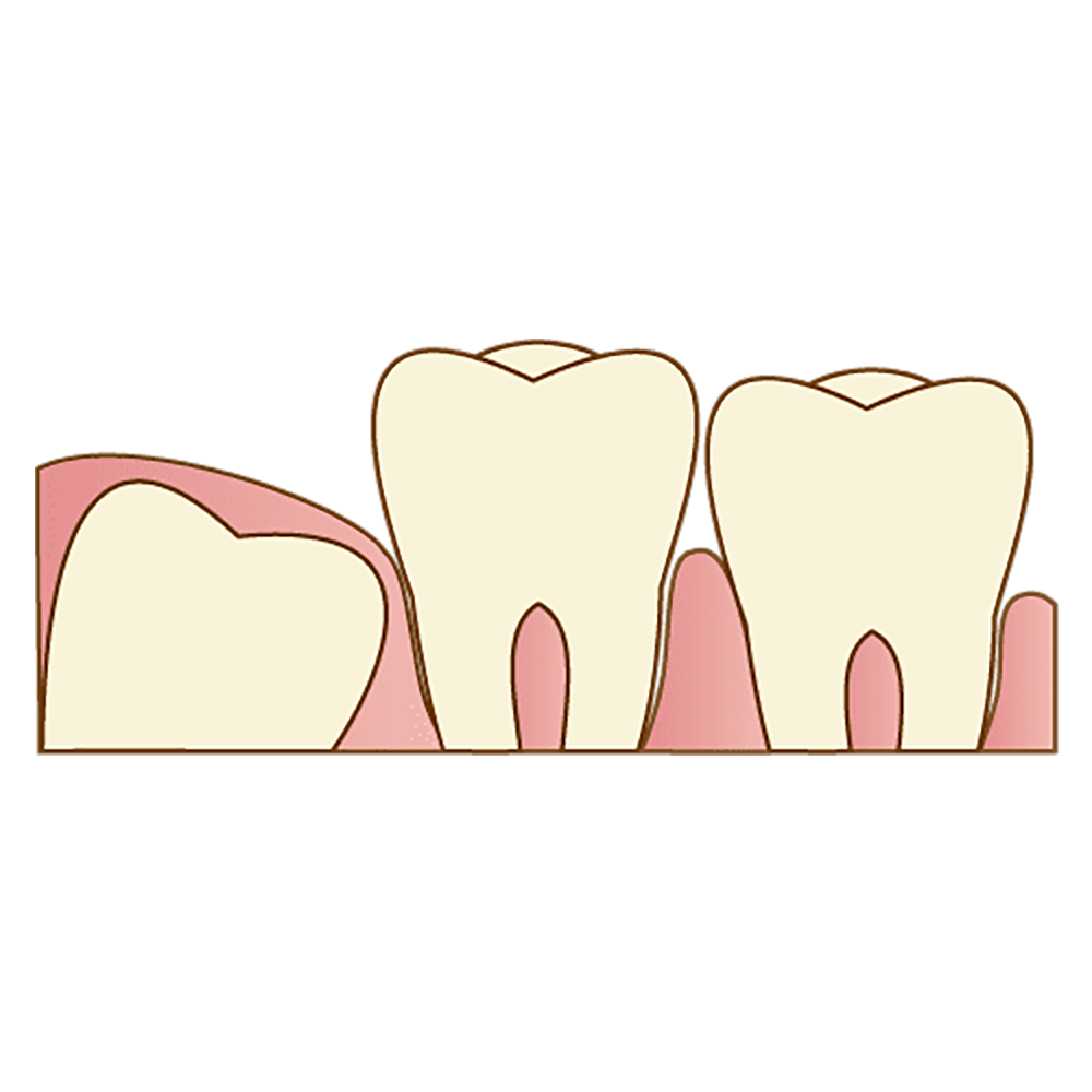 親知らずとは？