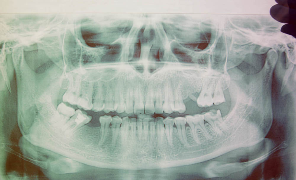 親知らずは抜いたほうがいい？